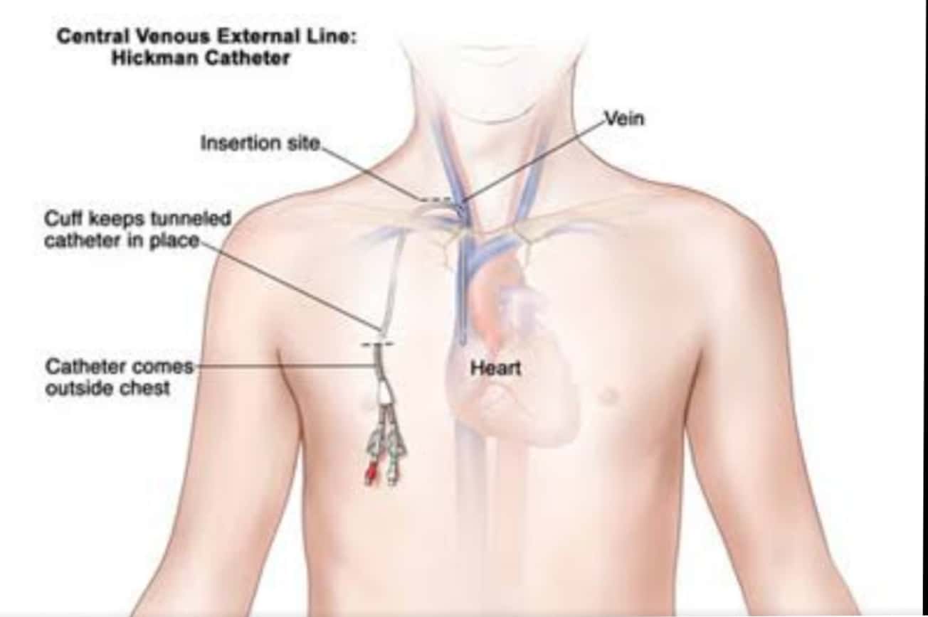 PICC Clinic (Peripherally Inserted Central Catheter ) Dr. Masurkar's