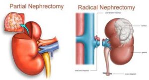 LAPROSCOPIC/OPEN RADICAL NEPHRECTOMY - Dr. Masurkar